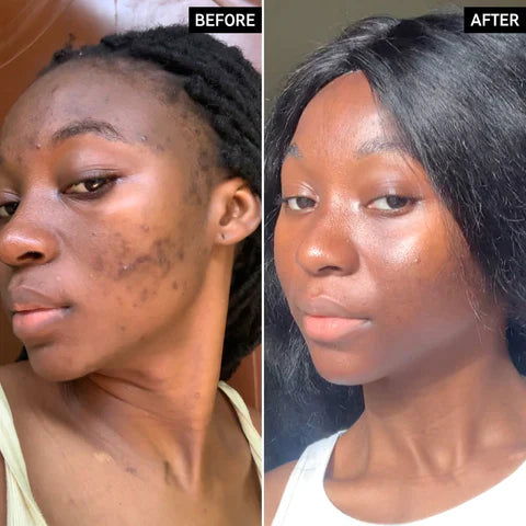 Turmeric Lemon Kojic Acid Soap Bar - YezNatural.com